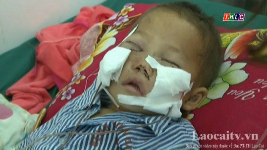 Huyện Bảo Thắng: Bé trai bị chó cắn vào mặt gây thương tích nặng