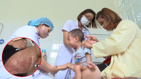 Lào Cai: Gia tăng bệnh nhi mắc bệnh mùa hè