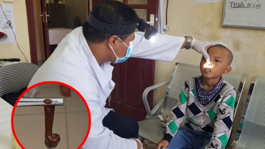 Gắp con nấc sống trong mũi một bé trai ở Mường Khương