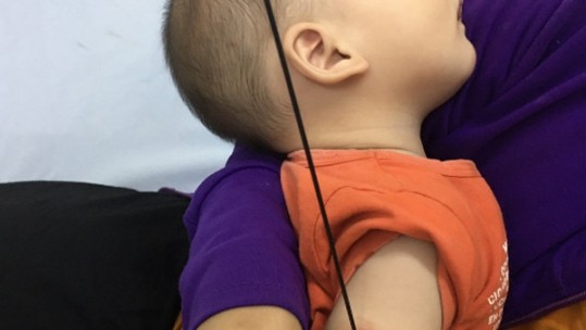 Bé 6 tháng tuổi không may bị nan ô đâm xuyên cánh tay