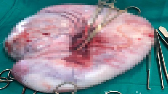 Lấy thành công khối u nặng gần 6 kg ra khỏi bụng bệnh nhân