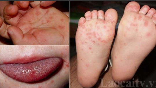 Cần cẩn trọng với bệnh tay - chân - miệng